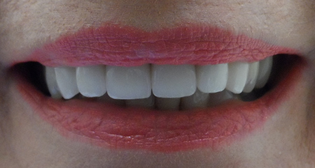 Smile transformation two, after treatment