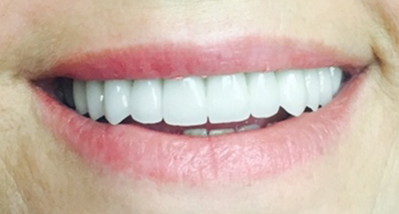 Smile transformation one, after treatment