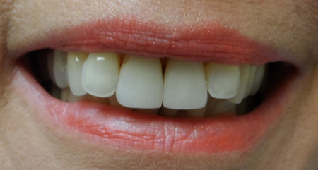 Smile transformation two, before treatment
