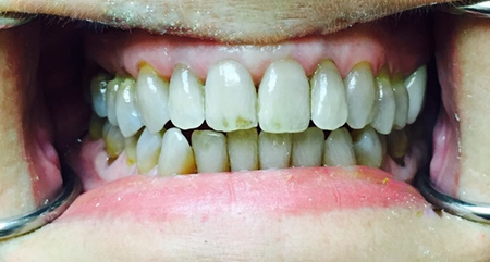 Smile transformation one, before treatment