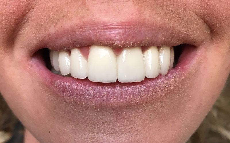 Wedding smile case, after treatment