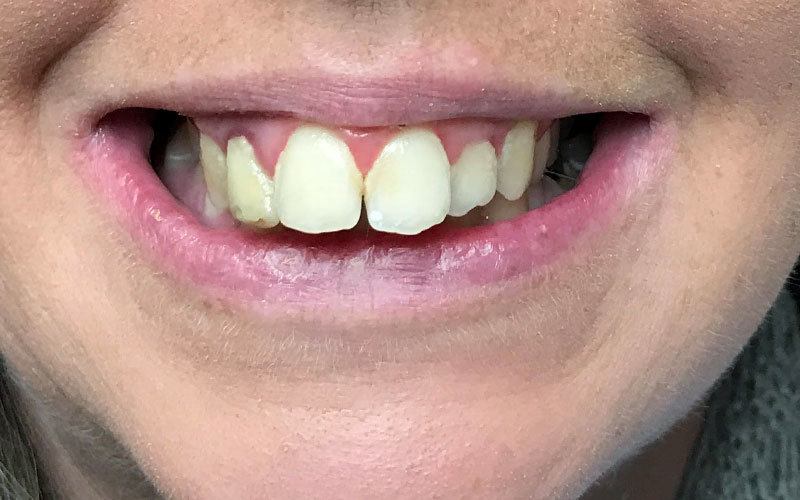 Wedding smile case, before treatment