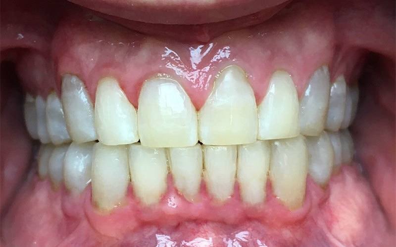 Crossbite case, after treatment