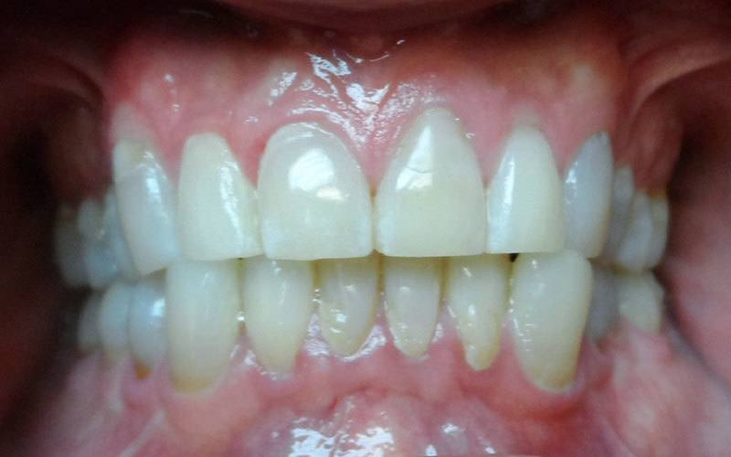 Crossbite case, before treatment